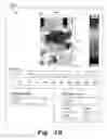 Fig. 07 - Thigh adhesion quantitative measurement system