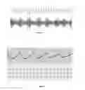 Fig. 02 - Method and device for assessing a mortality risk of a cardiac patient based on respiratory sinus arrhythmia