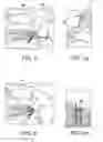 Fig. 04 - Method for knotless fixation of tissue