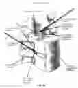 Fig. 62 - METHOD AND APPARATUS FOR CLOSING A FISSURE IN THE ANNULUS OF AN INTERVERTEBRAL DISC, AND/OR FOR EFFECTING OTHER ANATOMICAL REPAIRS AND/OR FIXATIONS