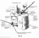 Fig. 65 - METHOD AND APPARATUS FOR CLOSING A FISSURE IN THE ANNULUS OF AN INTERVERTEBRAL DISC, AND/OR FOR EFFECTING OTHER ANATOMICAL REPAIRS AND/OR FIXATIONS