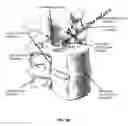 Fig. 67 - METHOD AND APPARATUS FOR CLOSING A FISSURE IN THE ANNULUS OF AN INTERVERTEBRAL DISC, AND/OR FOR EFFECTING OTHER ANATOMICAL REPAIRS AND/OR FIXATIONS