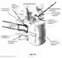 Fig. 68 - METHOD AND APPARATUS FOR CLOSING A FISSURE IN THE ANNULUS OF AN INTERVERTEBRAL DISC, AND/OR FOR EFFECTING OTHER ANATOMICAL REPAIRS AND/OR FIXATIONS