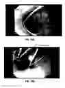 Fig. 15 - Apparatus and method for placement of device along wall of a body lumen
