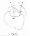 Fig. 05 - Left atrial appendage occlusion device