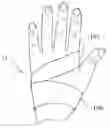 Fig. 01 - Method of transradial catheterization, device for ulnar artery compression, and method of use
