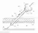 Fig. 01 - COLLAPSIBLE SHEATH AND TAPERED DILATOR FOR TISSUE PUNCTURE ACCESS