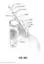 Fig. 100 - Systems and methods for fusing a sacroiliac joint and anchoring an orthopedic appliance