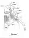 Fig. 101 - Systems and methods for fusing a sacroiliac joint and anchoring an orthopedic appliance