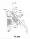 Fig. 102 - Systems and methods for fusing a sacroiliac joint and anchoring an orthopedic appliance