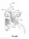 Fig. 103 - Systems and methods for fusing a sacroiliac joint and anchoring an orthopedic appliance