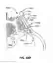 Fig. 113 - Systems and methods for fusing a sacroiliac joint and anchoring an orthopedic appliance