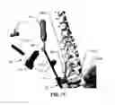 Fig. 124 - Systems and methods for fusing a sacroiliac joint and anchoring an orthopedic appliance