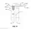 Fig. 13 - Systems and methods for fusing a sacroiliac joint and anchoring an orthopedic appliance