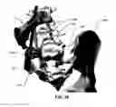 Fig. 131 - Systems and methods for fusing a sacroiliac joint and anchoring an orthopedic appliance