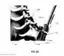 Fig. 138 - Systems and methods for fusing a sacroiliac joint and anchoring an orthopedic appliance