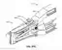 Fig. 152 - Systems and methods for fusing a sacroiliac joint and anchoring an orthopedic appliance
