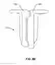 Fig. 153 - Systems and methods for fusing a sacroiliac joint and anchoring an orthopedic appliance