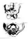 Fig. 155 - Systems and methods for fusing a sacroiliac joint and anchoring an orthopedic appliance