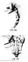 Fig. 159 - Systems and methods for fusing a sacroiliac joint and anchoring an orthopedic appliance