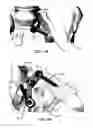 Fig. 162 - Systems and methods for fusing a sacroiliac joint and anchoring an orthopedic appliance
