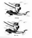 Fig. 176 - Systems and methods for fusing a sacroiliac joint and anchoring an orthopedic appliance