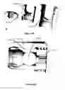 Fig. 181 - Systems and methods for fusing a sacroiliac joint and anchoring an orthopedic appliance