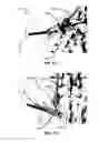 Fig. 191 - Systems and methods for fusing a sacroiliac joint and anchoring an orthopedic appliance
