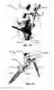 Fig. 192 - Systems and methods for fusing a sacroiliac joint and anchoring an orthopedic appliance