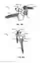 Fig. 200 - Systems and methods for fusing a sacroiliac joint and anchoring an orthopedic appliance