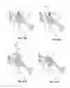 Fig. 69 - Systems and methods for fusing a sacroiliac joint and anchoring an orthopedic appliance