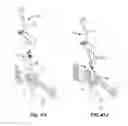 Fig. 70 - Systems and methods for fusing a sacroiliac joint and anchoring an orthopedic appliance