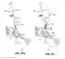 Fig. 71 - Systems and methods for fusing a sacroiliac joint and anchoring an orthopedic appliance