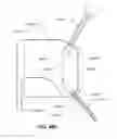 Fig. 77 - Systems and methods for fusing a sacroiliac joint and anchoring an orthopedic appliance
