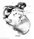 Fig. 79 - Systems and methods for fusing a sacroiliac joint and anchoring an orthopedic appliance