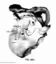 Fig. 80 - Systems and methods for fusing a sacroiliac joint and anchoring an orthopedic appliance