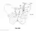 Fig. 86 - Systems and methods for fusing a sacroiliac joint and anchoring an orthopedic appliance