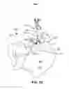 Fig. 91 - Systems and methods for fusing a sacroiliac joint and anchoring an orthopedic appliance