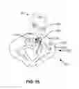 Fig. 93 - Systems and methods for fusing a sacroiliac joint and anchoring an orthopedic appliance