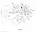 Fig. 97 - Systems and methods for fusing a sacroiliac joint and anchoring an orthopedic appliance