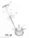 Fig. 06 - Bone treatment systems and methods