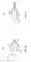 Fig. 12 - Methods and apparatuses for remodeling tissue of or adjacent to a body passage