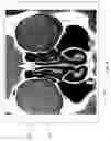 Fig. 05 - System for tracking guidewire with ray tracing capability