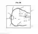 Fig. 06 - Treatment apparatus for a subretinal injection and method for assisting in a subretinal injection