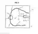 Fig. 07 - Treatment apparatus for a subretinal injection and method for assisting in a subretinal injection
