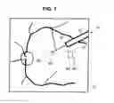 Fig. 08 - Treatment apparatus for a subretinal injection and method for assisting in a subretinal injection