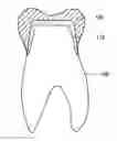 Fig. 01 - Apparatus and method for improving adhesive strength of dental restoration