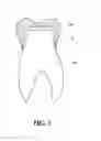 Fig. 02 - Apparatus and method for improving adhesive strength of dental restoration