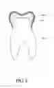 Fig. 03 - Apparatus and method for improving adhesive strength of dental restoration