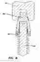 Fig. 08 - Dental implant with interlocking and centering threads